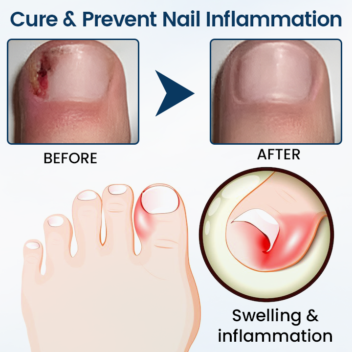 🔥Ourlyard® NailGuard Fungal Repair Herbal Spray